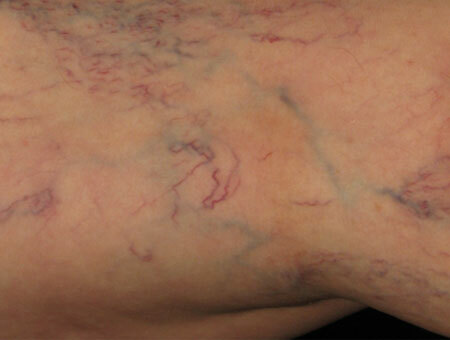 Clinical symptoms of varicose veins, photo 1