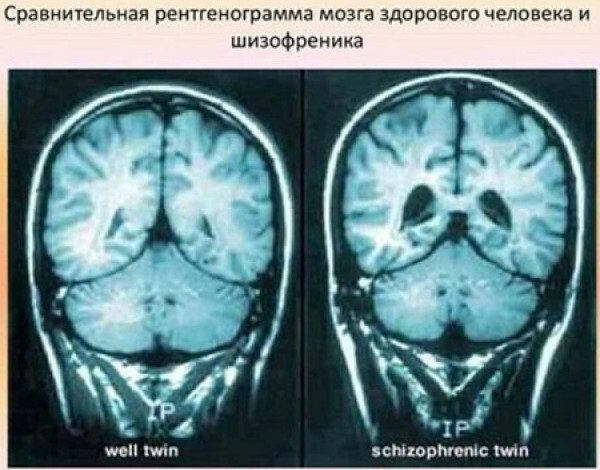 כיצד לקבוע סכיזופרניה באדם על ידי MRI, מראה, רישומים