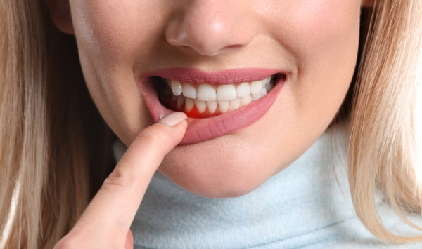 Gums bleed. Home treatment, ointments, tablets, folk remedies