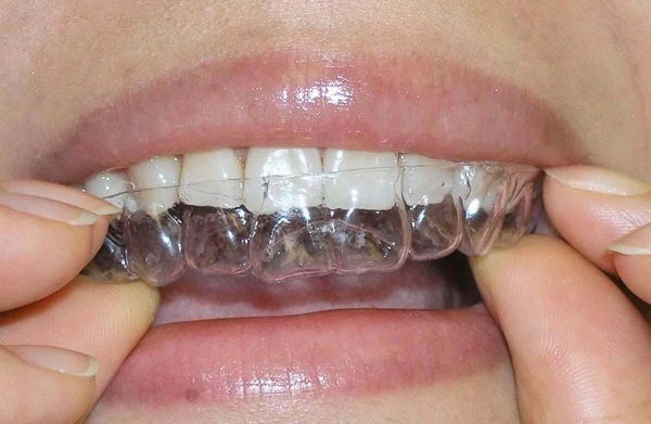 Restauração estética do dente Gradia GC Japão com compomir, folheado. É como instalar um pino de fibra de vidro. Fotos antes e depois