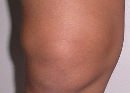 Zapalenie błony maziowej stawu kolanowego: objawy, leczenie, formy zapalenia błony maziowejMed. Consultant - Health On-Line