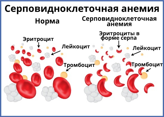 Splenectomy. Consequences for the body, as the operation is called, diet, rehabilitation