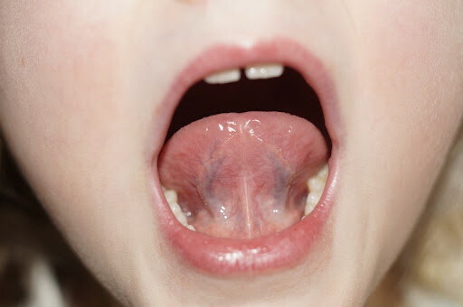 Blå årer under tungen. Hva er det, grunner
