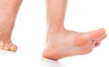 Diabetic foot: what is it? The initial stage( photo)