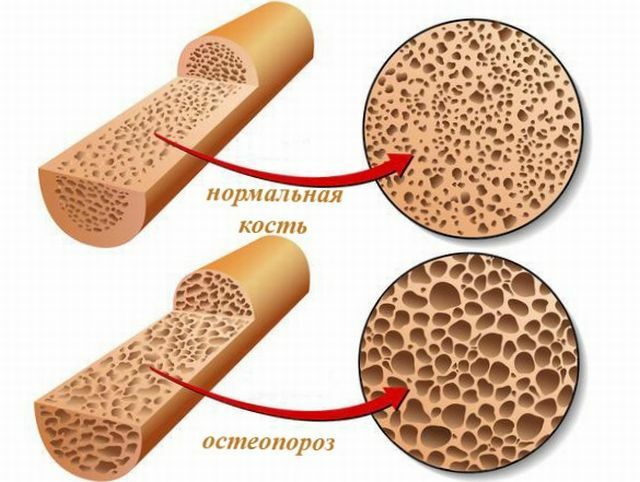 Hvad er osteoporose