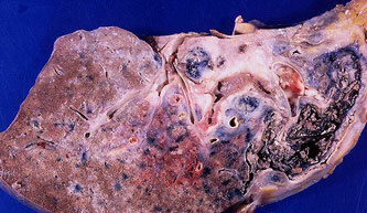 Symptoms and signs of pulmonary sarcoidosis