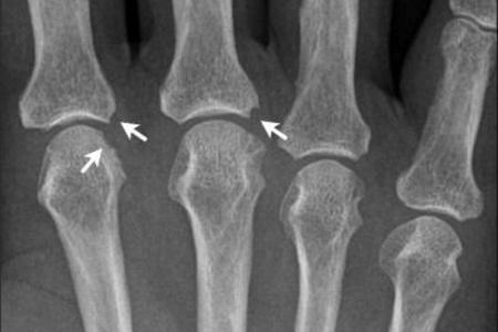 Osteoporosis y un ligero estrechamiento del espacio articular( etapa 2).Radiografía de los huesos