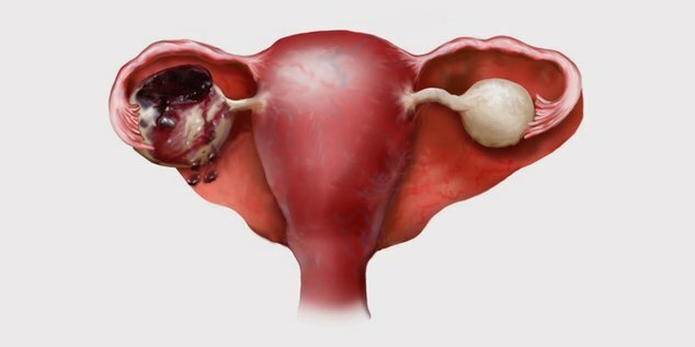 Ruptura corpului galben ovarian