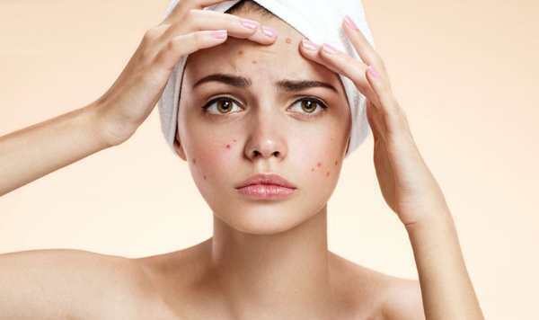 Small purulent pimples on the face of women. Causes and treatment, how to get rid