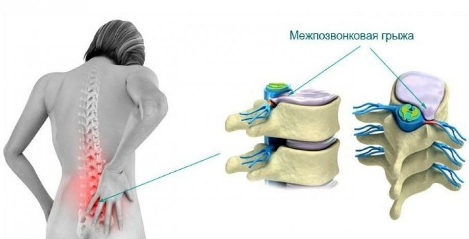 Herniated disc of lumbar spine: treatment, symptoms - detailed information