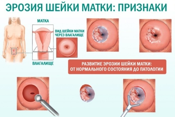 Precancerous condition of the cervix. What is it, name, treatment of 1-2-3 degrees