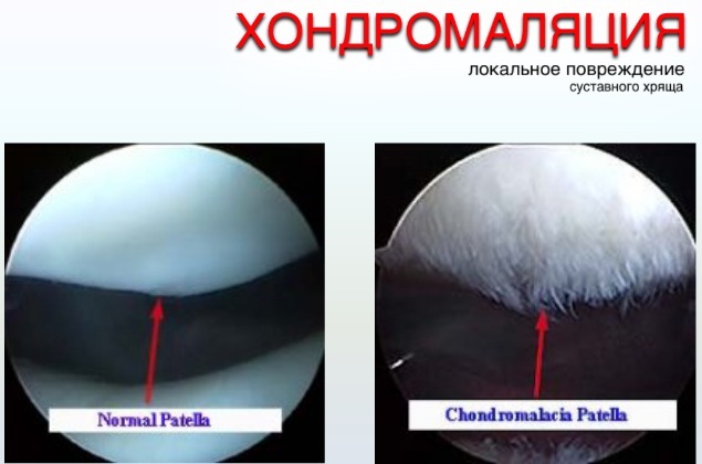 Chondromalacia of the patella 1-2-3-4 degrees. What is it, causes, symptoms, treatment
