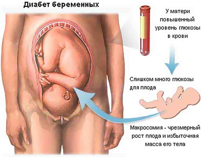 Aumento de la glucosa en sangre durante el embarazo.