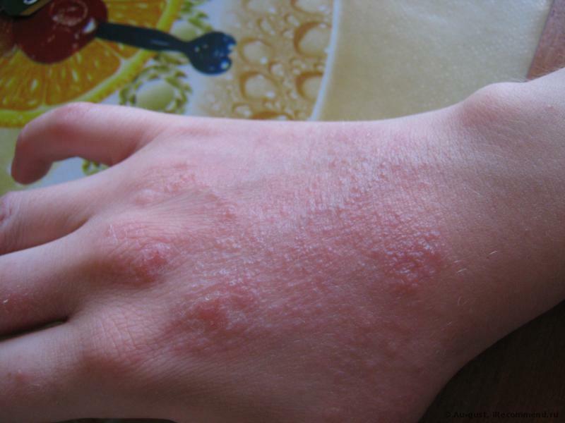 El tratamiento correcto del eczema será determinado por un médico