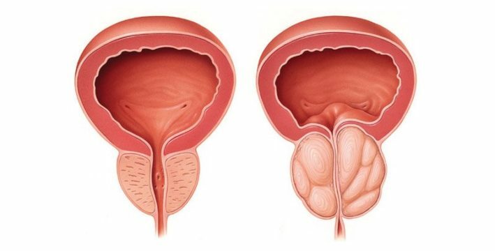 Signs of prostatitis and prostate adenoma