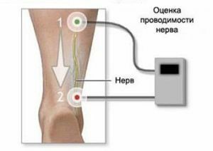 evaluation of nerve conduction