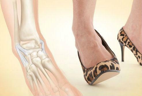 Il meccanismo più frequente di dislocazione della caviglia