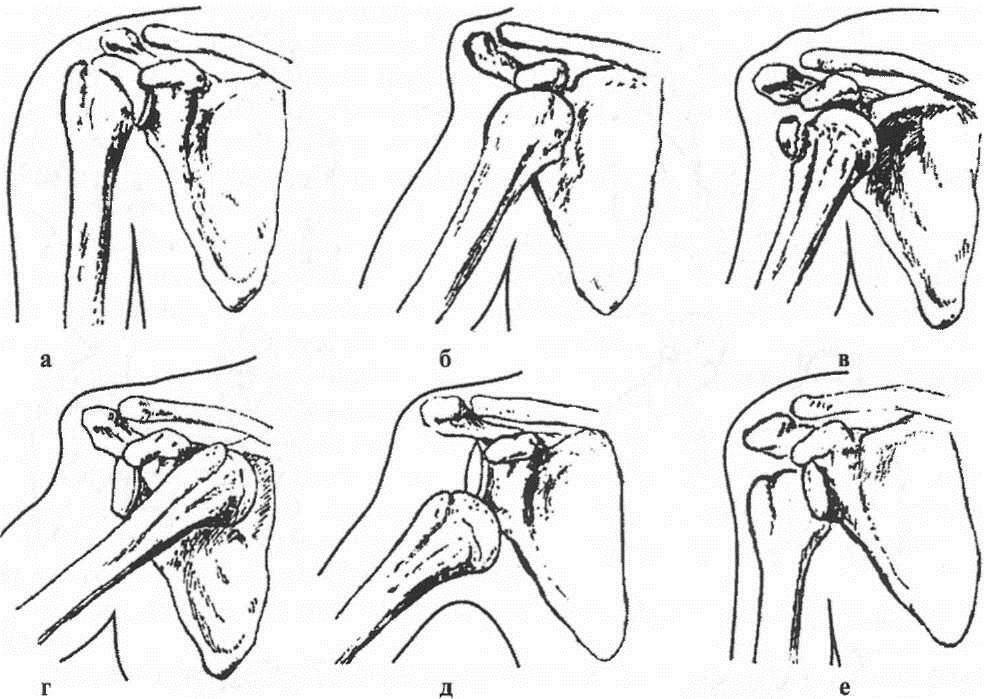 Classification of shoulder dislocations according to Kaplan: a - normal joint;b - subclavicular dislocation;c - sublingus dislocation with a detachment of the large tubercle of the humerus;d - subclavian;d - axillary;e - back