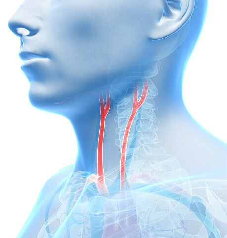 Neck vascular stenosis. Symptoms and treatment, surgery