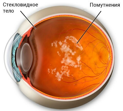 Zerstörung des Glaskörpers des Auges. Was ist, Behandlung