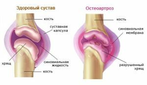 zajednički osteoartritis