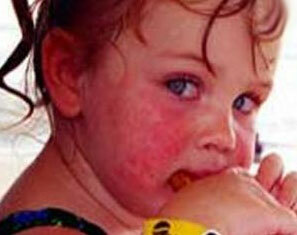 Ką alergija atrodo vaikams?