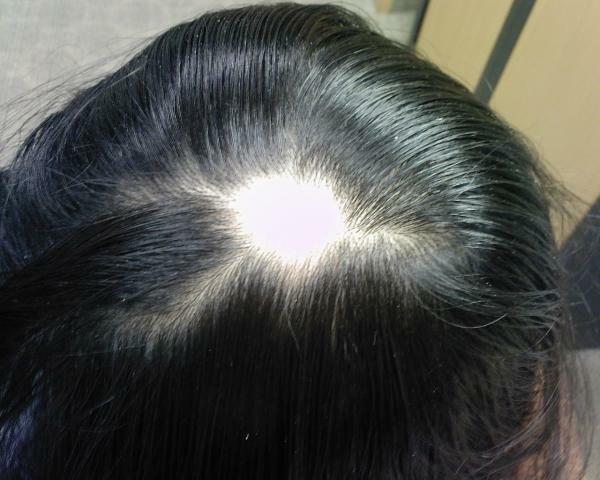 Alopecia areata hos kvinnor: behandling