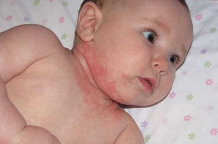 Emothenes with atopic dermatitis in children