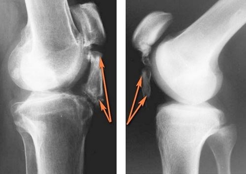Inflammation of the tendons of the knee joint. Treatment, symptoms, causes in children, athletes, x-rays
