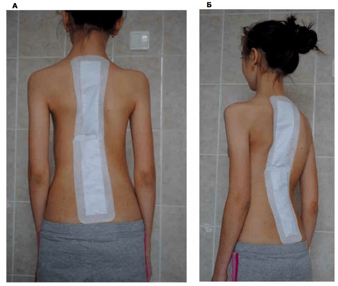 Patient after surgical treatment of scoliosis