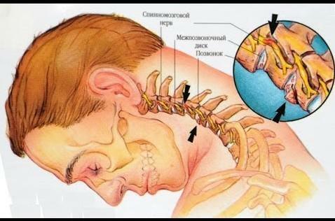 Osteochondrosis pada tulang belakang leher rahim