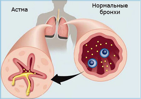 Tubos brônquicos normais e com ataque de asma