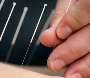 akupunkturprocedure