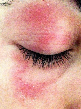 symptoms of dermatitis