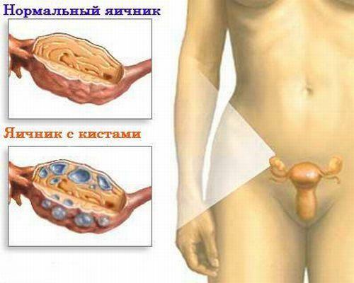 Perbedaan ovarium normal dari ovarium dengan kista