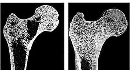Osteoporose hos kvinder