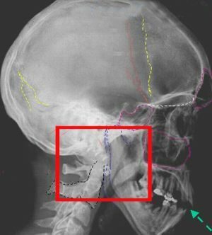 fracture of base of skull