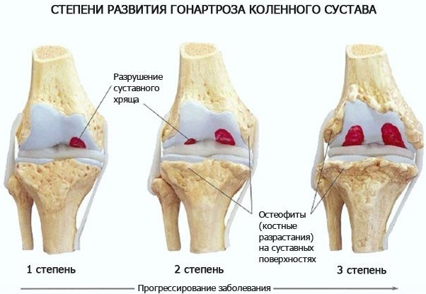 Knee endoprosthesis. Price, types, service life, photos, reviews. Zimmer, Stryker, Biomet