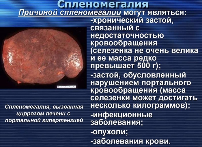 Splenomegaly. What is it, how to treat, causes of moderate, minor, portal, severe, analyzes