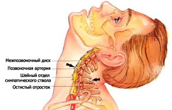 Cervical osteochondrosis in women. Signs, symptoms and treatments, gymnastics, medicine