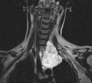 Hordoma: tumor hrbtenice in dna lobanje