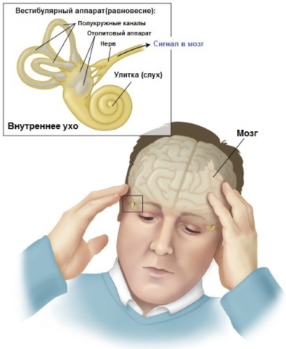 Severe dizziness, darkening of the eyes, nausea, loss of coordination in women and men. Causes