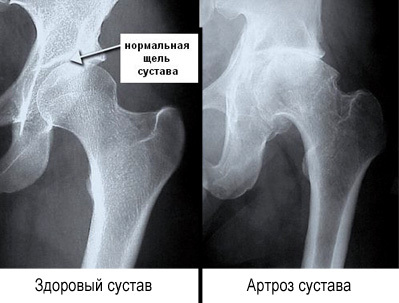 Coxartrosis de la articulación de la cadera de segundo grado. Tratamiento con remedios caseros, medicamentos, operación.