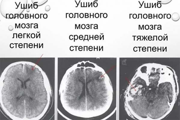 Traumatic brain injury. What is it, symptoms, first aid, consequences, classification, treatment