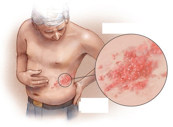 Zoster in adults, children. How to treat pink, herpes, ringworm, red, lichen planus