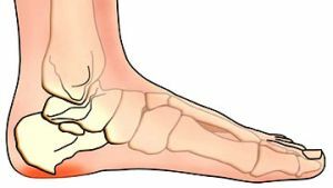 ayağındaki osteofitler