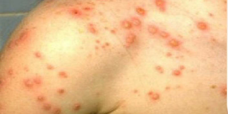 Chicken pox in adults