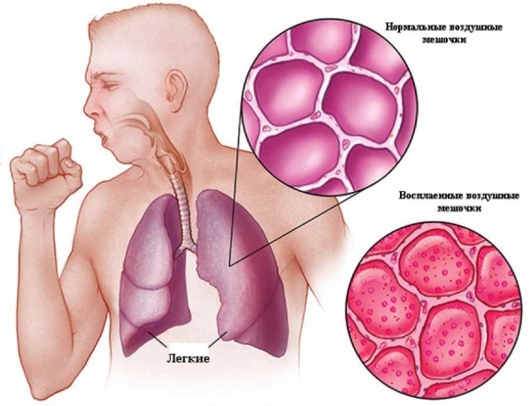 Fokal lungebetennelse hos barn og voksne. Symptomer, diagnose, kliniske retningslinjer