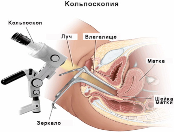 Laser removal of a polyp of the uterus, endometrial hysteroscopy. Preparation, recovery period