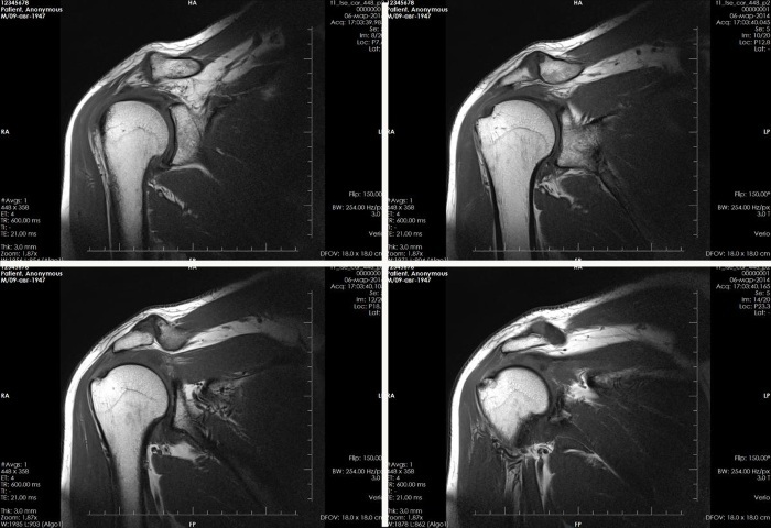 MRI of the shoulder joint. Price, which shows how the procedure is going, what can be found